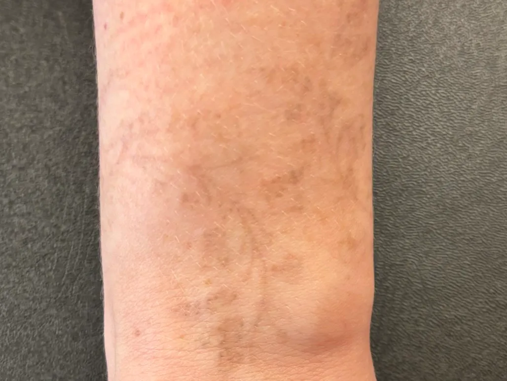 The same wrist after a course of laser removal, the floral design faded to a shadow