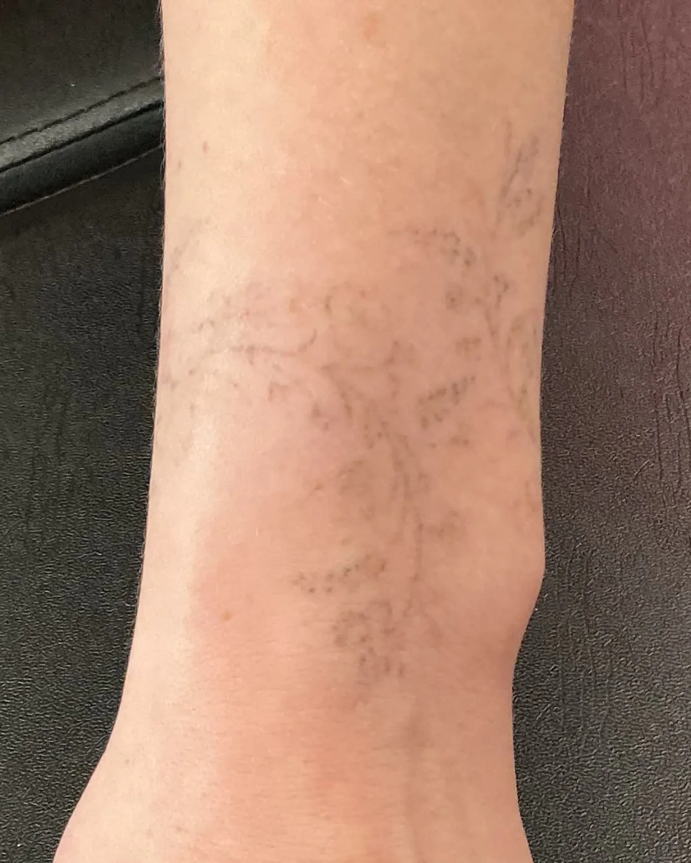 The same wrist after a course of laser removal, the floral design faded to a shadow