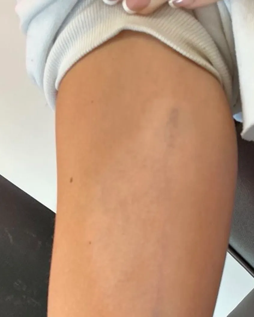 The same upper arm after a course of laser removal, with the tattoo almost entirely cleared