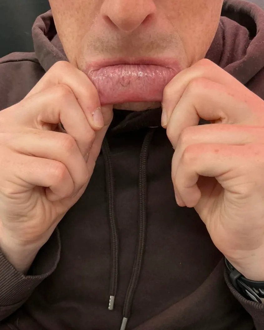 The same lower lip after laser removal, with the lettering cleared