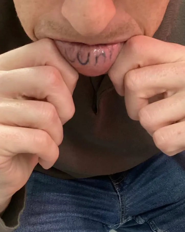 Lettering tattooed inside a lower lip, before laser removal