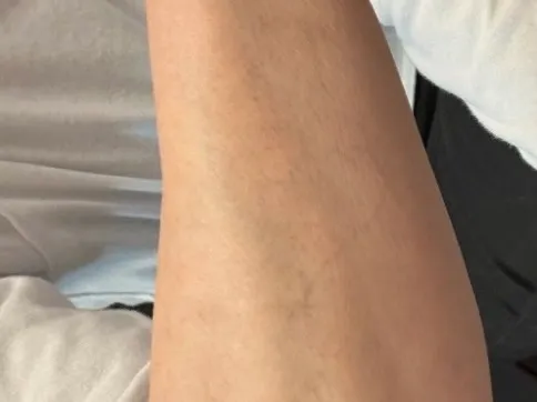 The same forearm after five sessions of laser removal, the script no longer visible