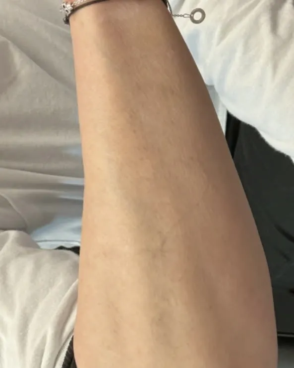 The same forearm after five sessions of laser removal, the script no longer visible