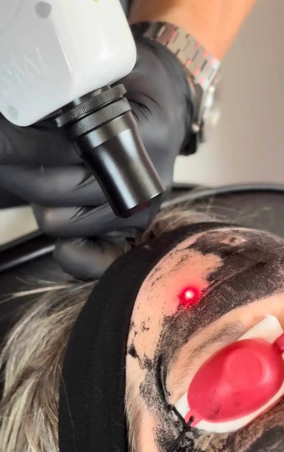 A carbon facial in progress: the laser passing over the carbon layer on a client’s forehead
