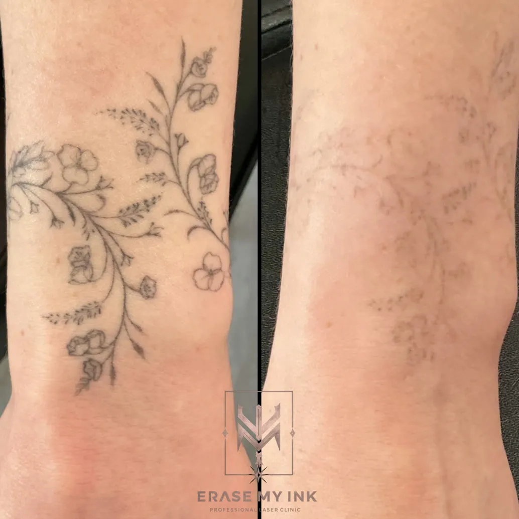 A floral wrist tattoo before treatment and after laser removal