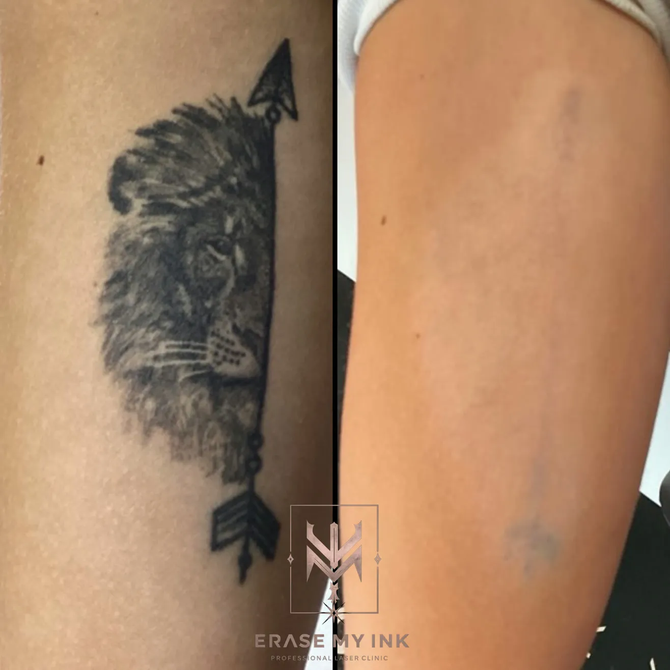 A lion and arrow forearm tattoo before treatment and after laser removal