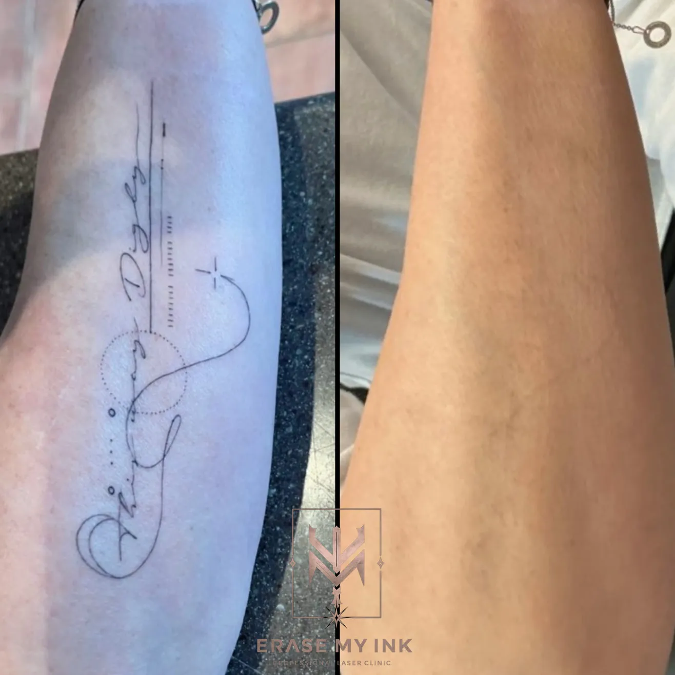 A script tattoo before treatment and after laser removal