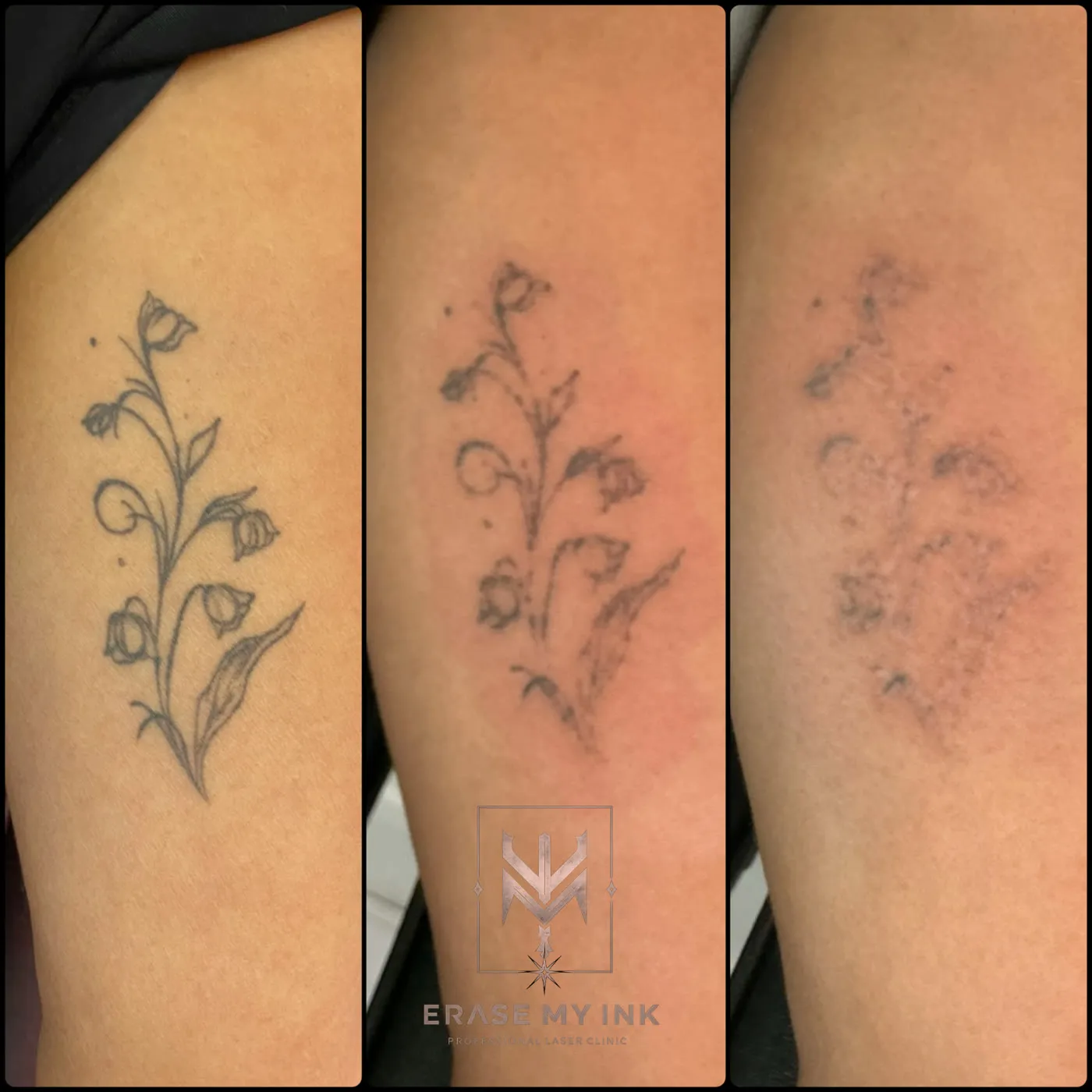 The same fine line floral tattoo at three stages of laser removal, from fully defined to almost gone